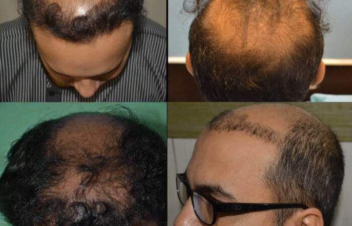 Gevaren van een goedkope haartransplantatie