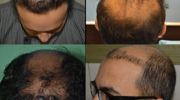 Gevaren van een goedkope haartransplantatie