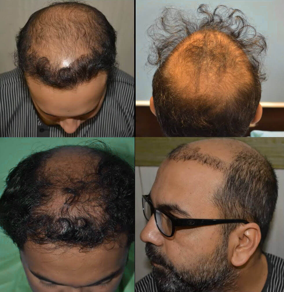 Gevaren van een goedkope haartransplantatie